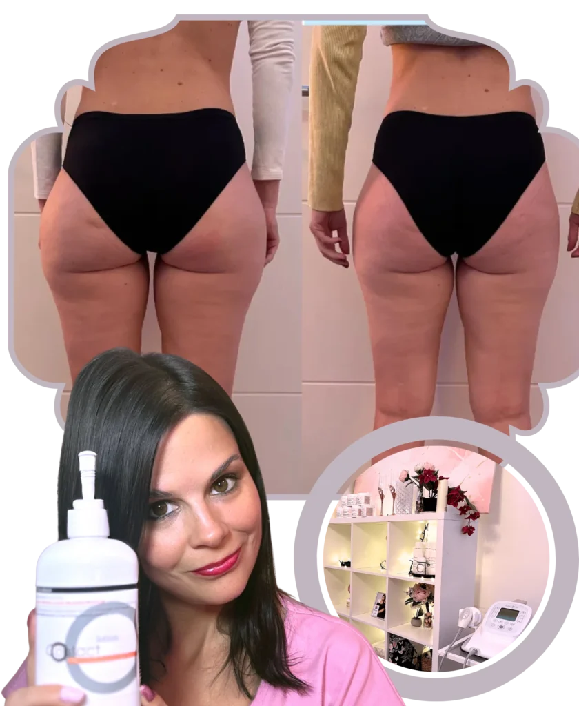 narancsbőr ellen lipozero